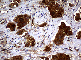 NME1 / NM23 Antibody - IHC of paraffin-embedded Carcinoma of Human bladder tissue using anti-NME1 mouse monoclonal antibody.