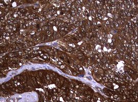 NME1 / NM23 Antibody - IHC of paraffin-embedded Adenocarcinoma of Human endometrium tissue using anti-NME1 mouse monoclonal antibody.