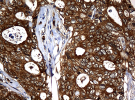 NME1 / NM23 Antibody - IHC of paraffin-embedded Adenocarcinoma of Human breast tissue using anti-NME1 mouse monoclonal antibody.
