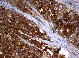 NME1 / NM23 Antibody - IHC of paraffin-embedded Adenocarcinoma of Human colon tissue using anti-NME1 mouse monoclonal antibody.