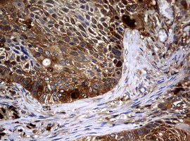 NME1 / NM23 Antibody - IHC of paraffin-embedded Carcinoma of Human lung tissue using anti-NME1 mouse monoclonal antibody.