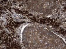NME1 / NM23 Antibody - Immunohistochemical staining of paraffin-embedded Carcinoma of Human lung tissue using anti-NME1 mouse monoclonal antibody.  heat-induced epitope retrieval by 10mM citric buffer, pH6.0, 120C for 3min)