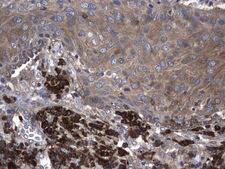 NME1 / NM23 Antibody - Immunohistochemical staining of paraffin-embedded Carcinoma of Human lung tissue using anti-NME1 mouse monoclonal antibody. heat-induced epitope retrieval by 10mM citric buffer, pH6.0, 120C for 3min)