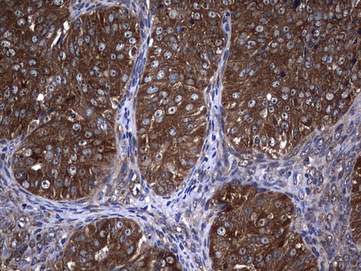 NME1 / NM23 Antibody - Immunohistochemical staining of paraffin-embedded Adenocarcinoma of Human ovary tissue using anti-NME1 mouse monoclonal antibody.  heat-induced epitope retrieval by 10mM citric buffer, pH6.0, 120C for 3min)
