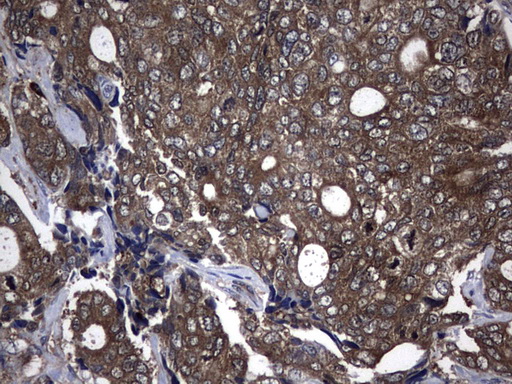NME1 / NM23 Antibody - Immunohistochemical staining of paraffin-embedded Adenocarcinoma of Human breast tissue using anti-NME1 mouse monoclonal antibody. (UM800023