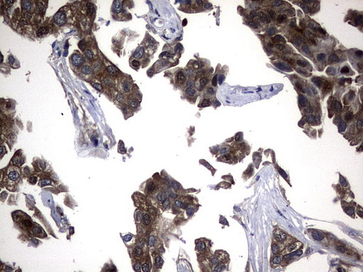 NME1 / NM23 Antibody - Immunohistochemical staining of paraffin-embedded Carcinoma of Human bladder tissue using anti-NME1 mouse monoclonal antibody.  heat-induced epitope retrieval by 10mM citric buffer, pH6.0, 120C for 3min)