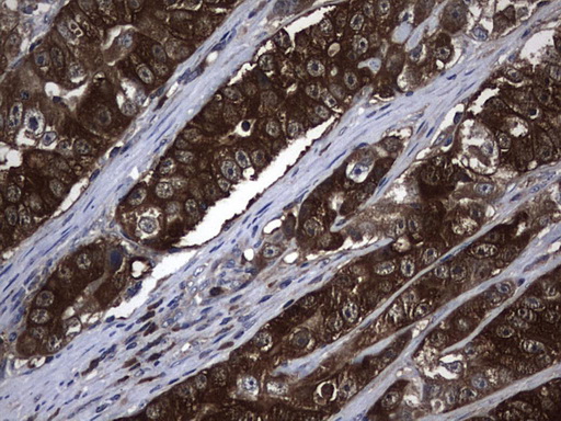 NME1 / NM23 Antibody - Immunohistochemical staining of paraffin-embedded Adenocarcinoma of Human colon tissue using anti-NME1 mouse monoclonal antibody.  heat-induced epitope retrieval by 10mM citric buffer, pH6.0, 120C for 3min)