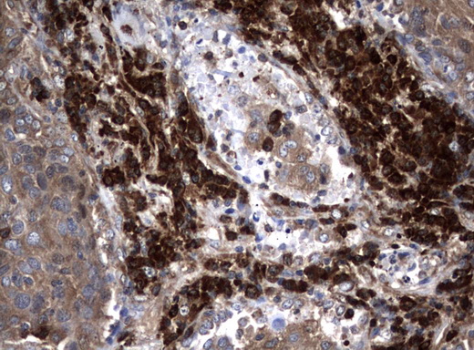 NME1 / NM23 Antibody - Immunohistochemical staining of paraffin-embedded Carcinoma of Human lung tissue using anti-NME1 mouse monoclonal antibody.  heat-induced epitope retrieval by 10mM citric buffer, pH6.0, 120C for 3min)