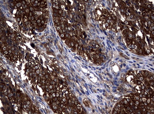 NME1 / NM23 Antibody - Immunohistochemical staining of paraffin-embedded Adenocarcinoma of Human ovary tissue using anti-NME1 mouse monoclonal antibody.  heat-induced epitope retrieval by 10mM citric buffer, pH6.0, 120C for 3min)