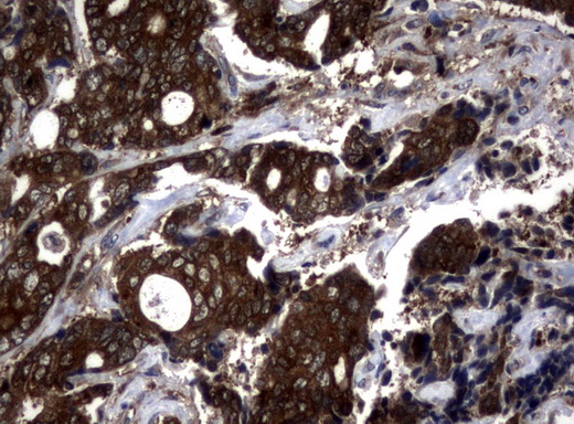 NME1 / NM23 Antibody - Immunohistochemical staining of paraffin-embedded Adenocarcinoma of Human breast tissue using anti-NME1 mouse monoclonal antibody.  heat-induced epitope retrieval by 10mM citric buffer, pH6.0, 120C for 3min)