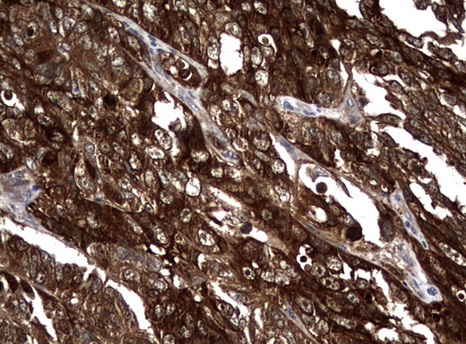 NME1 / NM23 Antibody - Immunohistochemical staining of paraffin-embedded Adenocarcinoma of Human endometrium tissue using anti-NME1 mouse monoclonal antibody.  heat-induced epitope retrieval by 10mM citric buffer, pH6.0, 120C for 3min)