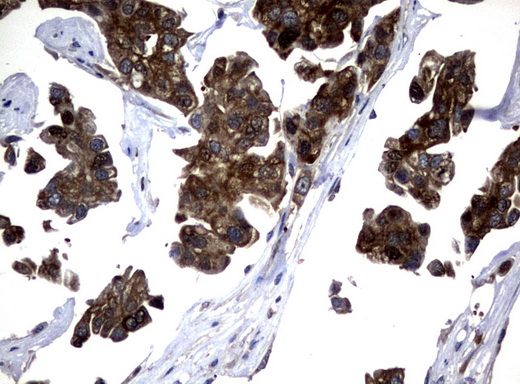 NME1 / NM23 Antibody - Immunohistochemical staining of paraffin-embedded Carcinoma of Human bladder tissue using anti-NME1 mouse monoclonal antibody.  heat-induced epitope retrieval by 10mM citric buffer, pH6.0, 120C for 3min)