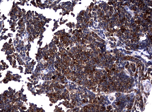 NME1 / NM23 Antibody - Immunohistochemical staining of paraffin-embedded Human lymphoma tissue using anti-NME1 mouse monoclonal antibody.  heat-induced epitope retrieval by 10mM citric buffer, pH6.0, 120C for 3min)