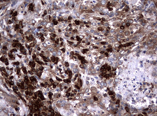 NME1 / NM23 Antibody - Immunohistochemical staining of paraffin-embedded Carcinoma of Human lung tissue using anti-NME1 mouse monoclonal antibody.  heat-induced epitope retrieval by 10mM citric buffer, pH6.0, 120C for 3min)