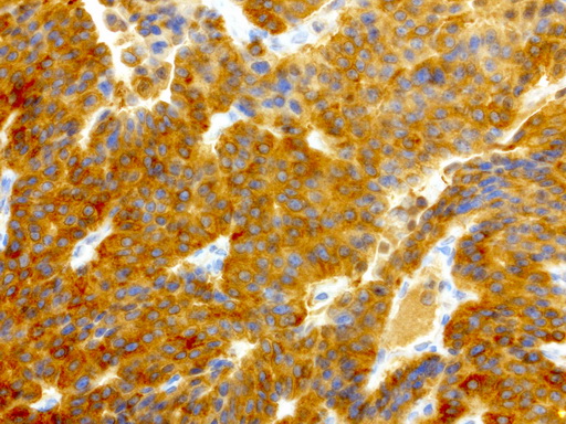 NME1 / NM23 Antibody - Immunohistochemical staining of paraffin-embedded human lung cancer using anti-NME1 clone UMAB94 mouse monoclonal antibody  at 1:4000 with Polink2 Broad HRP DAB detection kit; heat-induced epitope retrieval with GBI ACCEL pH8.7 HIER buffer using pressure chamber for 3 minutes at 110C. Cytoplasmic staining is very strong in the tumor cells.