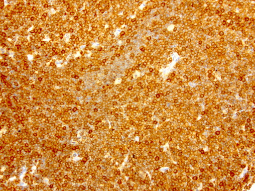 NME1 / NM23 Antibody - Immunohistochemical staining of paraffin-embedded human lymphoma using anti-NME1 clone UMAB94 mouse monoclonal antibody  at 1:8000 with Polink2 Broad HRP DAB detection kit; heat-induced epitope retrieval with GBI ACCEL pH8.7 HIER buffer using pressure chamber for 3 minutes at 110C. Cytoplasmic staining is very strong in the tumor cells.
