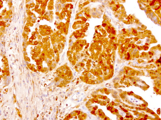NME1 / NM23 Antibody - Immunohistochemical staining of paraffin-embedded human ovarian carcinoma using anti-NME1 clone UMAB94 mouse monoclonal antibody  at 1:8000 with Polink2 Broad HRP DAB detection kit; heat-induced epitope retrieval with GBI ACCEL pH8.7 HIER buffer using pressure chamber for 3 minutes at 110C. Cytoplasmic staining is very strong in the tumor cells.