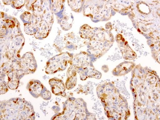 NME1 / NM23 Antibody - Immunohistochemical staining of paraffin-embedded human placenta using anti-NME1 clone UMAB94 mouse monoclonal antibody  at 1:4000 with Polink2 Broad HRP DAB detection kit; heat-induced epitope retrieval with GBI ACCEL pH8.7 HIER buffer using pressure chamber for 3 minutes at 110C. Cytoplasmic staining is very strong in the stromal cells but weak to no staining seen in the trophoblast cell.