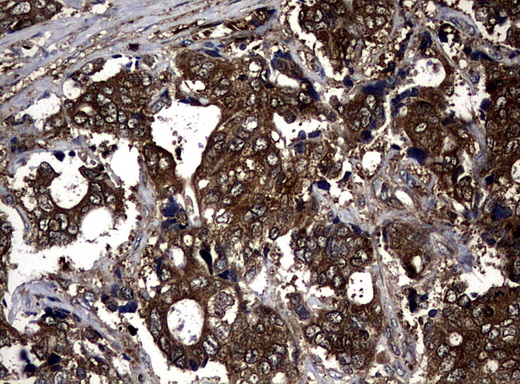 NME1 / NM23 Antibody - Immunohistochemical staining of paraffin-embedded Adenocarcinoma of Human breast tissue using anti-NME1 mouse monoclonal antibody.  heat-induced epitope retrieval by 10mM citric buffer, pH6.0, 120C for 3min)
