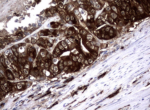 NME1 / NM23 Antibody - Immunohistochemical staining of paraffin-embedded Adenocarcinoma of Human colon tissue using anti-NME1 mouse monoclonal antibody.  heat-induced epitope retrieval by 10mM citric buffer, pH6.0, 120C for 3min)