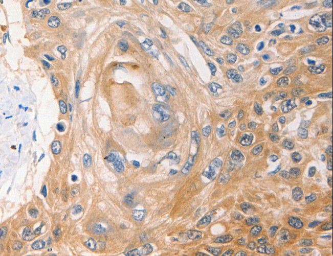 NME1 / NM23 Antibody - Immunohistochemistry of paraffin-embedded Human esophagus cancer using NME1 Polyclonal Antibody at dilution of 1:40.