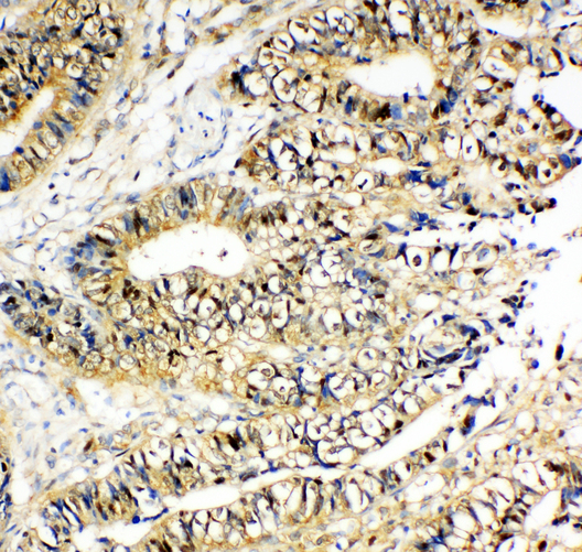 NME2 Antibody - NME2 / NM23 antibody. IHC(P): Human Intestinal Cancer Tissue.