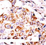 NME3 Antibody - Formalin-fixed and paraffin-embedded human cancer tissue reacted with the primary antibody, which was peroxidase-conjugated to the secondary antibody, followed by DAB staining. This data demonstrates the use of this antibody for immunohistochemistry; clinical relevance has not been evaluated. BC = breast carcinoma; HC = hepatocarcinoma.