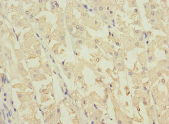 NME3 Antibody - Immunohistochemistry of paraffin-embedded human gastric cancer at dilution 1:100