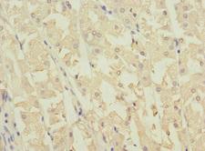 NME3 Antibody - Immunohistochemistry of paraffin-embedded human gastric cancer at dilution 1:100