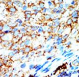 NME4 Antibody - Formalin-fixed and paraffin-embedded human cancer tissue reacted with the primary antibody, which was peroxidase-conjugated to the secondary antibody, followed by AEC staining. This data demonstrates the use of this antibody for immunohistochemistry; clinical relevance has not been evaluated. BC = breast carcinoma; HC = hepatocarcinoma.