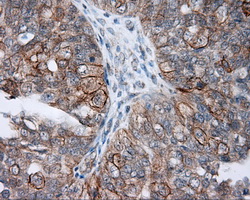 NME4 Antibody - IHC of paraffin-embedded Adenocarcinoma of ovary tissue using anti-NME4 mouse monoclonal antibody. (Dilution 1:50).