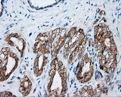 NME4 Antibody - IHC of paraffin-embedded Carcinoma of prostate tissue using anti-NME4 mouse monoclonal antibody. (Dilution 1:50).