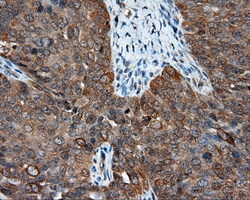 NME4 Antibody - IHC of paraffin-embedded Adenocarcinoma of ovary tissue using anti-NME4 mouse monoclonal antibody. (Dilution 1:50).