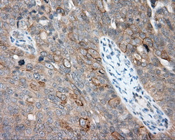 NME4 Antibody - Immunohistochemical staining of paraffin-embedded Adenocarcinoma of ovary tissue using anti-NME4 mouse monoclonal antibody. (Dilution 1:50).