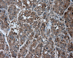 NME4 Antibody - Immunohistochemical staining of paraffin-embedded Carcinoma of liver tissue using anti-NME4 mouse monoclonal antibody. (Dilution 1:50).