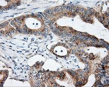 NME4 Antibody - IHC of paraffin-embedded Adenocarcinoma of colon tissue using anti-NME4 mouse monoclonal antibody. (Dilution 1:50).