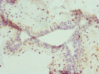NME4 Antibody - Immunohistochemistry of paraffin-embedded human breast cancer at dilution 1:100