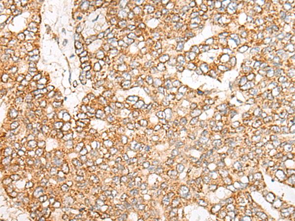 NME4 Antibody - Immunohistochemistry of paraffin-embedded Human liver cancer tissue  using NME4 Polyclonal Antibody at dilution of 1:45(×200)