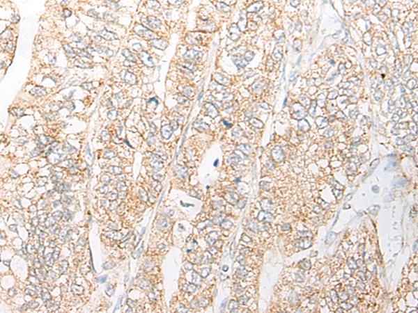 NME4 Antibody - Immunohistochemistry of paraffin-embedded Human gastric cancer tissue  using NME4 Polyclonal Antibody at dilution of 1:45(×200)