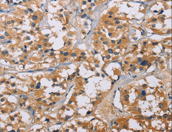 NME5 Antibody - Immunohistochemistry of paraffin-embedded Human liver cancer using NME5 Polyclonal Antibody at dilution of 1:50.