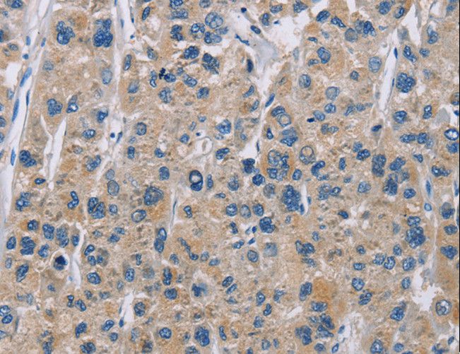 NME5 Antibody - Immunohistochemistry of paraffin-embedded Human liver cancer using NME5 Polyclonal Antibody at dilution of 1:50.
