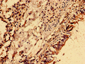 NME6 Antibody - Immunohistochemistry analysis of human lung cancer using NME6 Antibody at dilution of 1:100