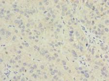 NME7 Antibody - Immunohistochemistry of paraffin-embedded human liver cancer using antibody at dilution of 1:100.