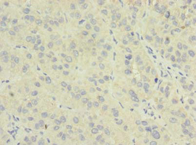 NME7 Antibody - Immunohistochemistry of paraffin-embedded human liver cancer using NME7 Antibody at dilution of 1:100