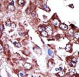NME7 Antibody - Formalin-fixed and paraffin-embedded human cancer tissue reacted with the primary antibody, which was peroxidase-conjugated to the secondary antibody, followed by AEC staining. This data demonstrates the use of this antibody for immunohistochemistry; clinical relevance has not been evaluated. BC = breast carcinoma; HC = hepatocarcinoma.
