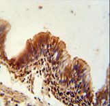 NME9 / TXNDC6 Antibody - TXNDC6 antibody immunohistochemistry of formalin-fixed and paraffin-embedded human lung carcinoma followed by peroxidase-conjugated secondary antibody and DAB staining.