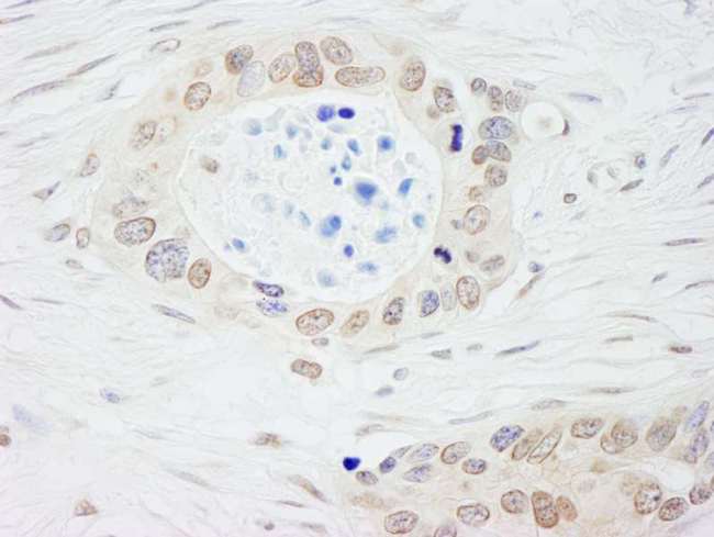 NMI Antibody - Detection of Human NMI by Immunohistochemistry. Sample: FFPE section of human ovarian carcinoma. Antibody: Affinity purified rabbit anti-NMI used at a dilution of 1:5000 (0.2 ug/ml). Detection: DAB.