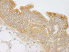 NMI Antibody - Detection of Human NMI by Immunohistochemistry. Sample: FFPE section of human mucinous ovarian carcinoma. Antibody: Affinity purified rabbit anti-NMI used at a dilution of 1:250.