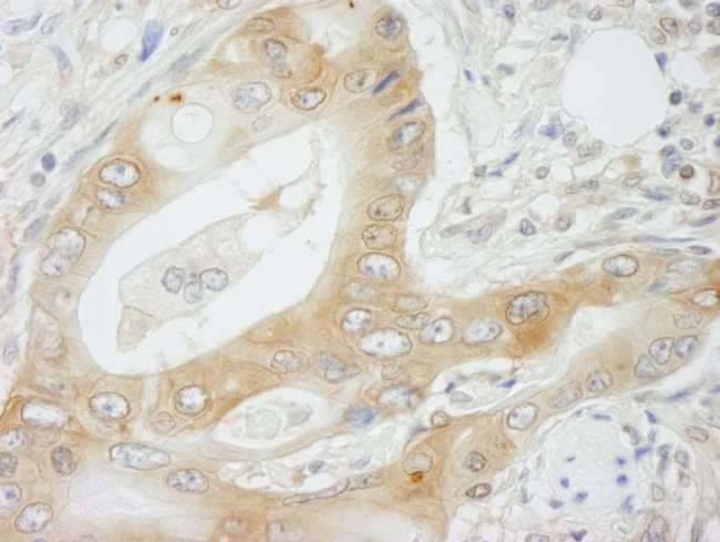 NMI Antibody - Detection of Human NMI by Immunohistochemistry. Sample: FFPE section of human colon adenocarcinoma. Antibody: Affinity purified rabbit anti-NMI used at a dilution of 1:250.