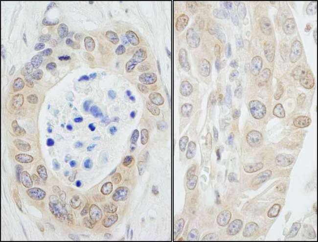 NMI Antibody - Detection of Human NMI by Immunohistochemistry. Sample: FFPE section of human ovarian carcinoma (left) and bladder carcinoma (right). Antibody: Affinity purified rabbit anti-NMI used at a dilution of 1:1000 (0.2 ug/ml). Detection: DAB.